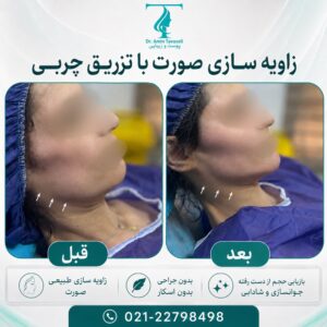 زاویه سازی صورت با تزریق چربی و نانوفت